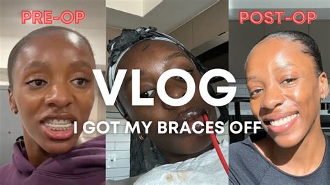 Vlog 18 I Got My Braces Off 7 5 Month Update From Double Jaw Surgery