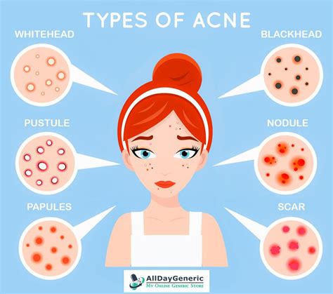 Types Of Acne Artofit