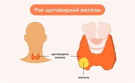 Рак щитовидной железы: описание, симптомы, диагностика и лечение | ЛабСтори