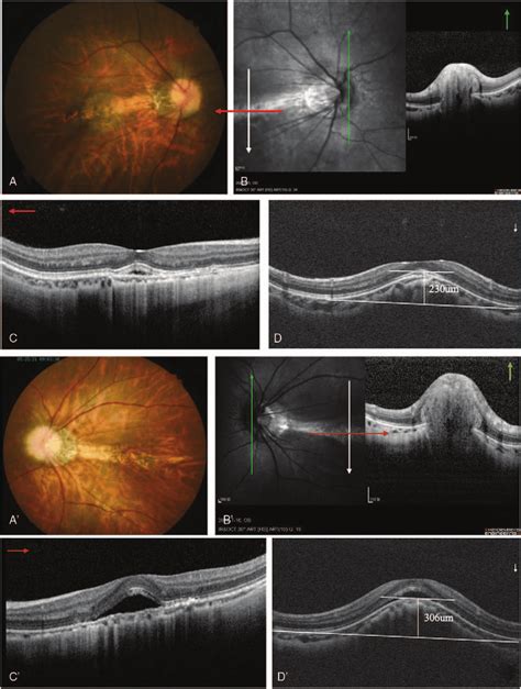 A 1a Color Retinography Showed Retinal Pigment Epithelial Changes