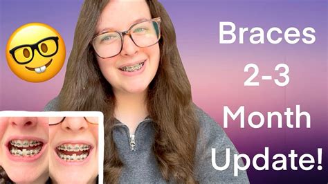 2 3 Month Braces Update Do Braces Help Stuttering Youtube