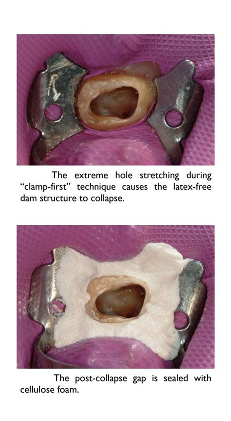 كيف نركب Rubber Dam Dentalbyhadeel Thread From هديل 🕊 Hadeel7m