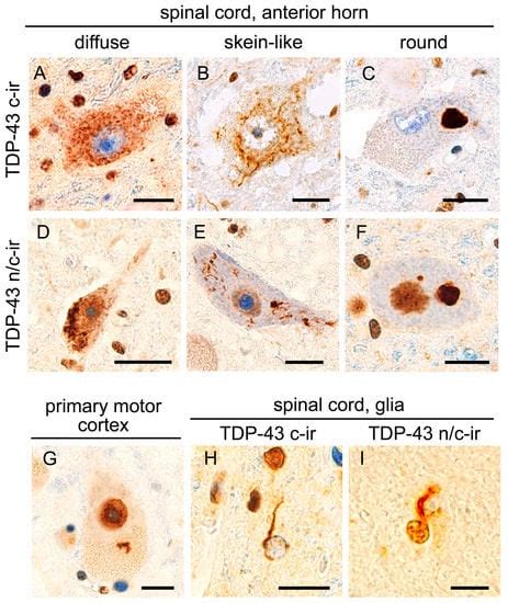 Ijms Free Full Text Nuclear Expression Of Tdp Is Linked With