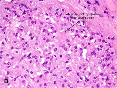 American Urological Association Testicular Tumors Of Adrenogenital