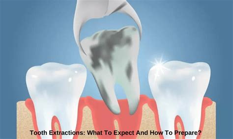 Tooth Extractions What To Expect And How To Prepare