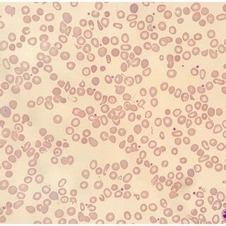 Peripheral Blood Film Shows Hypochromic Microcytic Erythrocytes