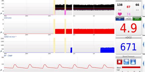 New Features LiDCO Hemodynamic Monitoring For The Entire Patient