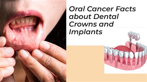 Oral Cancer Facts About Dental Crowns And Implants