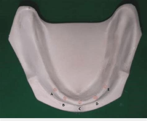 A B C D And E Implant Positions According To Misch Are Marked On