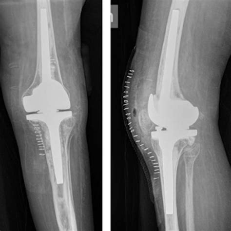 Post Operative X Ray A Antero Posterior View B Lateral View