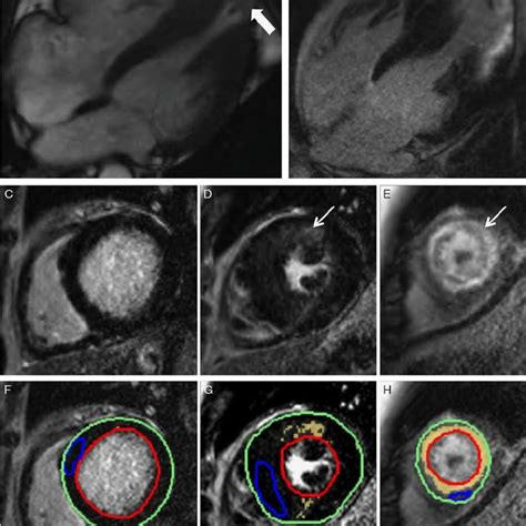 Cardiac MRI Findings | Download Table