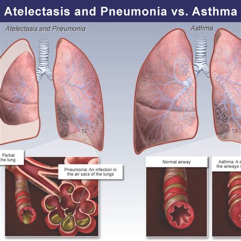 Right Pneumothorax Trial Exhibits Inc