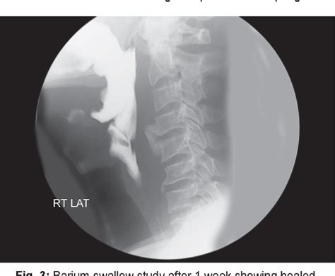 Esophageal Perforation Due To Anterior Cervical Osteophyte A Rare Case