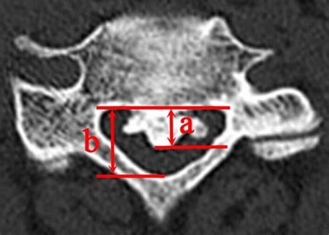 Measurement Of Ossification Of The Posterior Longitudinal Ligament Download Scientific Diagram