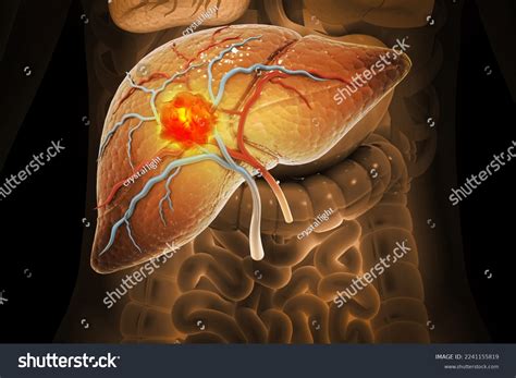 Hepatocellular Carcinoma Photos and Images | Shutterstock