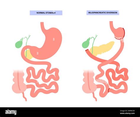 Biliopancreatic Diversion Procedure Illustration Stock Photo Alamy