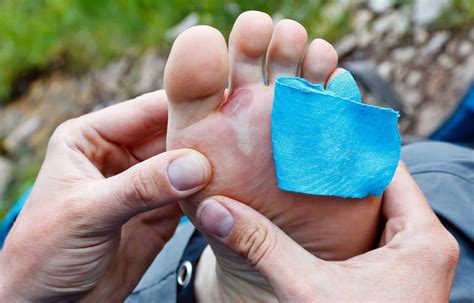 Preventing And Treating Blisters A Guide For Runners The Running Advisor