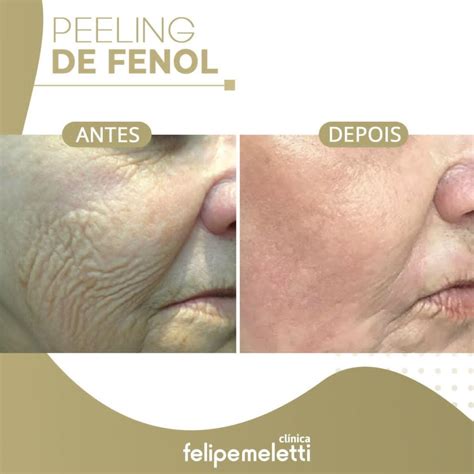 Peeling de Fenol Rejuvenesça até 10 anos em 3 meses