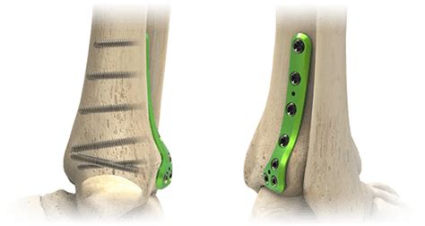 Acumed Ankle Plating System 3 Medical Optical