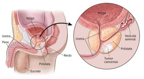 Qué Es El Cáncer De Próstata El Blog De Ch Salud