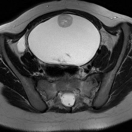 Ovarian dermoid cyst | Radiology Case | Radiopaedia.org