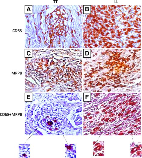 Positive Immunohistochemistry For Cd A Tt B Ll Mrp C Tt D