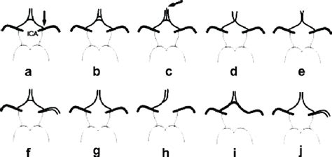 Anatomic Variations Of The Anterior Part Of The Circle Of Willis