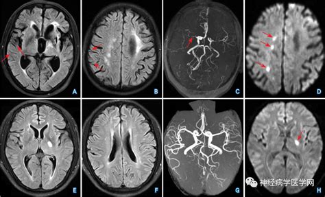 Flair血管高信号征的定义、影像表现、原理及临床应用！flairfvh脑梗死dwi血管动脉血流闭塞序列侧支 健康界