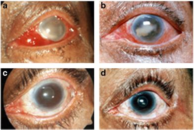 The Left Eye Shows Edematous Lids Congestion And Exudates In The