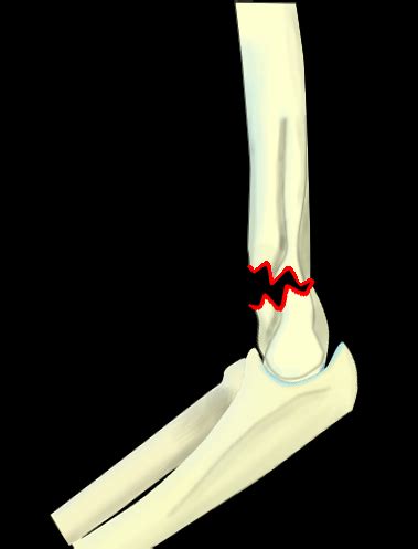 Supracondylar Fractures Gartland Classification Of Extension