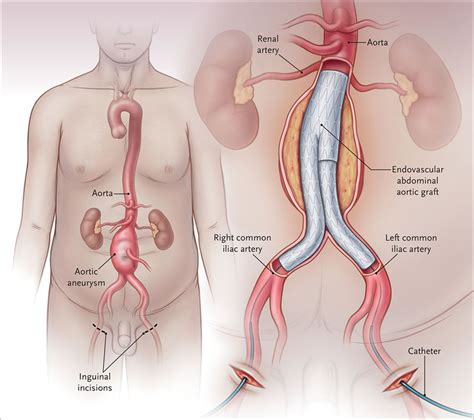 Abdominal Aorta Anatomy And Abdominal Aortic Aneurysm