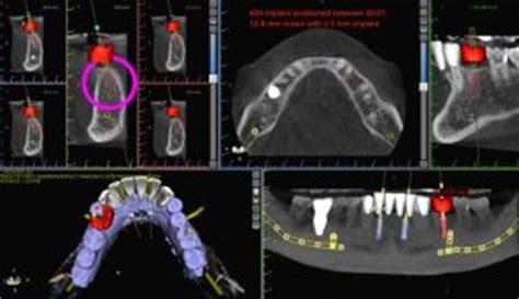 Five Benefits Of Cone Beam Ct Scan Cbct For Dental Implant Planning