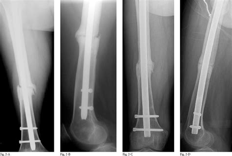 Femur Intramedullary Nailing Cpt Nail Ftempo