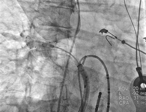 Best Practice Guide For Cryoballoon Ablation In Atrial Fibrillation The Compilation Experience