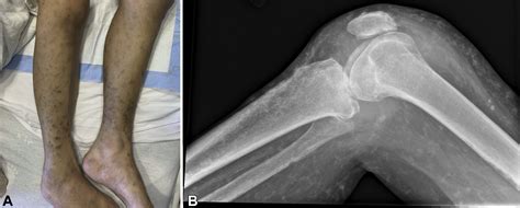 Cutaneous Oxalosis Mimicking Calcinosis Cutis In A Patient On