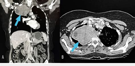 Ct Scan Right Paraspinal Apical Mass With Internal Cystic Areas Download Scientific Diagram