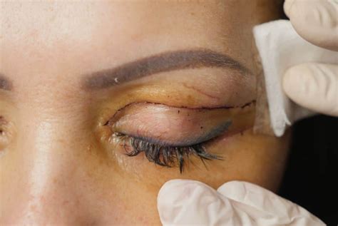 Upper Blepharoplasty Incision