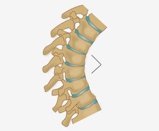 Kyphosis - Huffman Spine Clinic