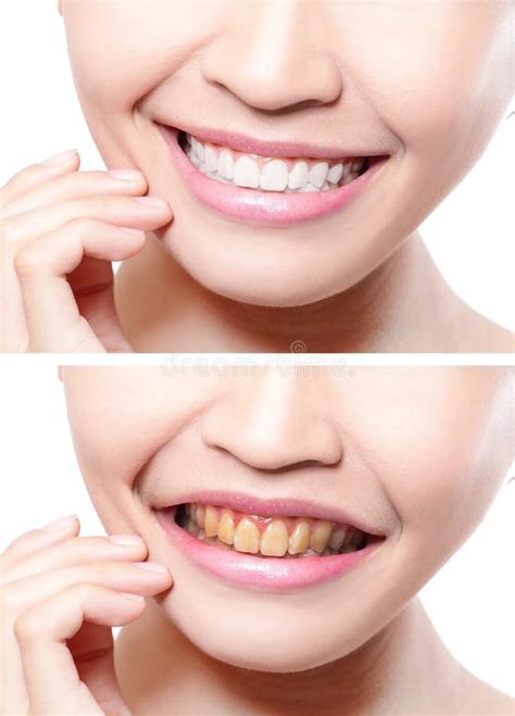 Dentes Da Mulher Antes E Depois Do Alvejante Imagem De Stock Imagem