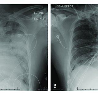 A Anterior Posterior Chest Radiograph On Hospital Day 1 Showing