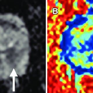 Images In A Year Old Man With Targeted Biopsy Proven Gleason