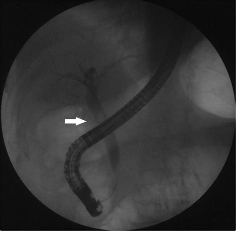 An Ercp Revealed A Dilated Common Bile Duct With A Round Filling Defect Download Scientific