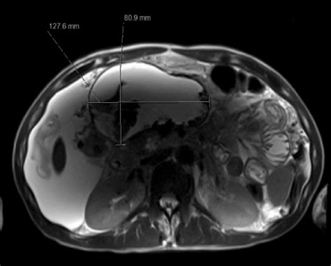 Mrcp Showing A 12 8×8 1×9 Cm Area Of Walled Off Necrosis In The Pancreas Download Scientific