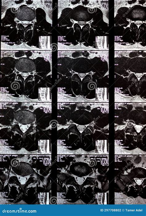 Cairo Egypt November Mri Of Lumbosacral Spine Revealed