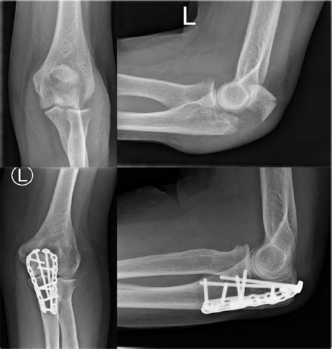 Fractures Of The Proximal Ulna Current Concepts In Surgical Management In Efort Open Reviews