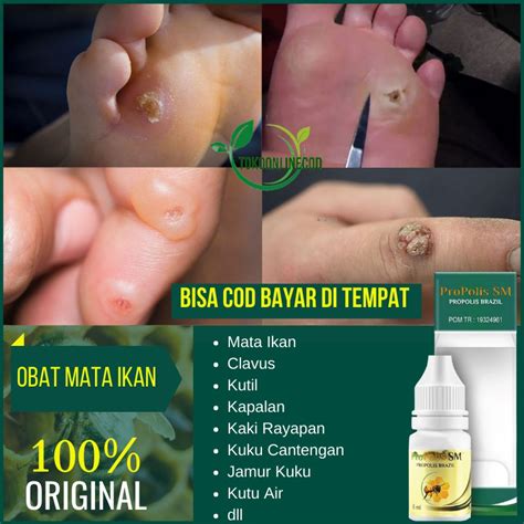 Jual Obat Mata Ikan Di Kaki Mata Ikan Di Tangan Mata Ikan Telapak