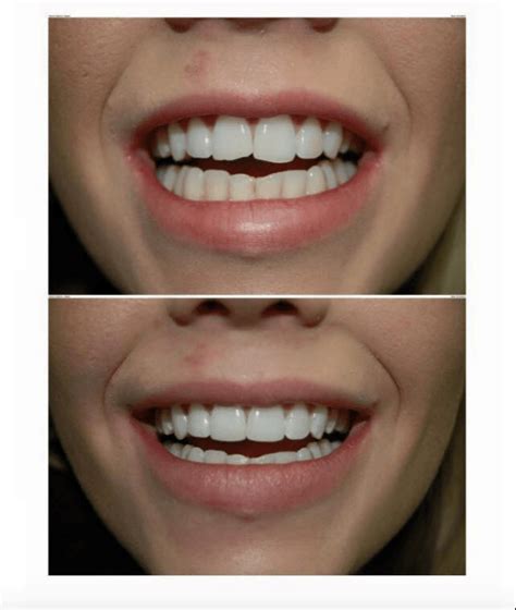 Veneers Cost In Unbiased Price Comparison By Dentists