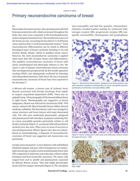 PDF Primary Neuroendocrine Breast Carcinoma A Rare Case Report