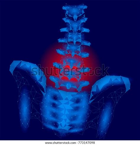 Human Spine Hip Lumbar Radiculitis Pain Stock Vector Royalty Free