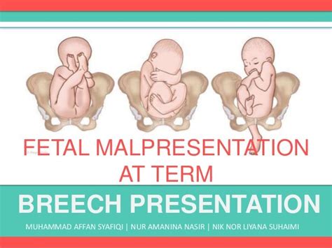 Breech Presentation